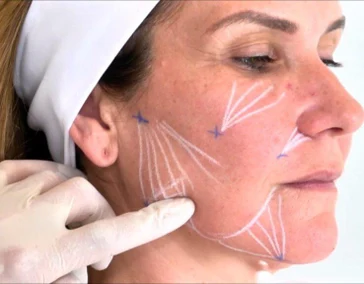 Коллагеностимуляция PLLA