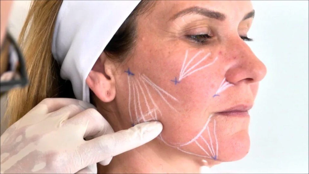 Векторный лифтинг PLLA