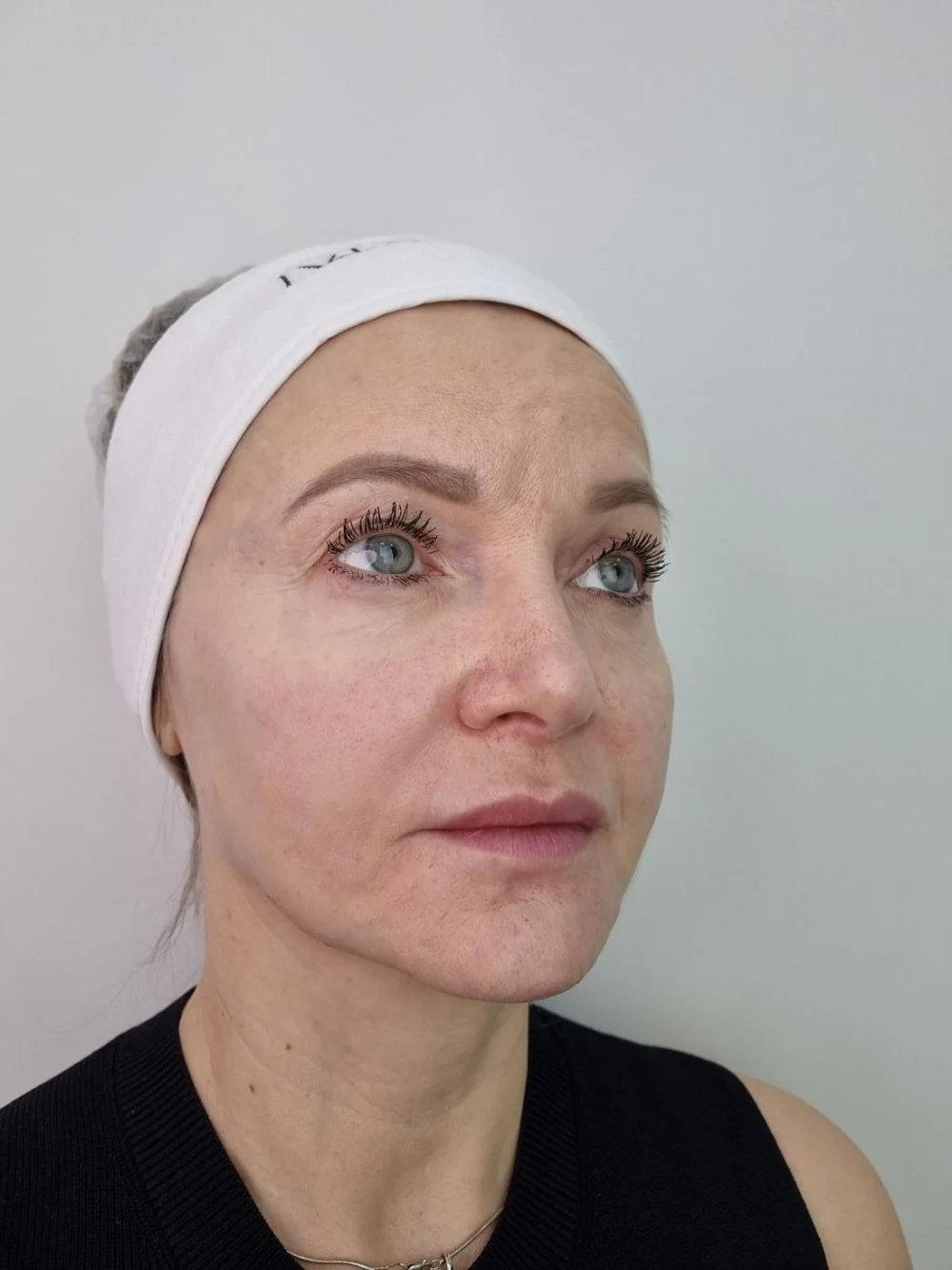 Коллагенотерапия  и Коллагеностимуляция