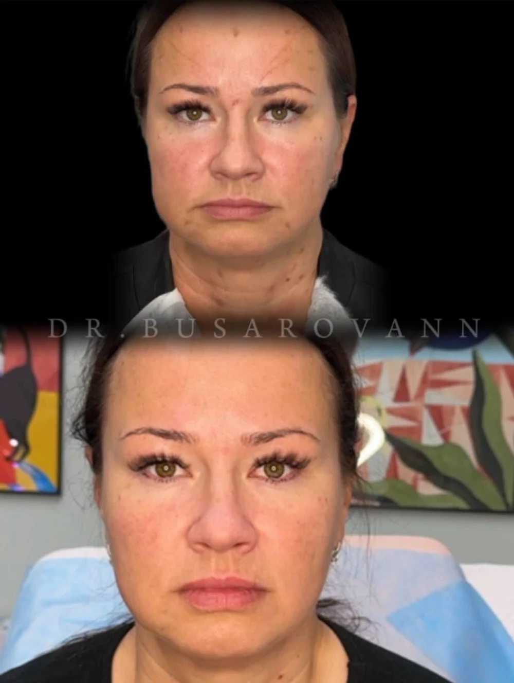 Ботулинотерапия (Ботокс) 