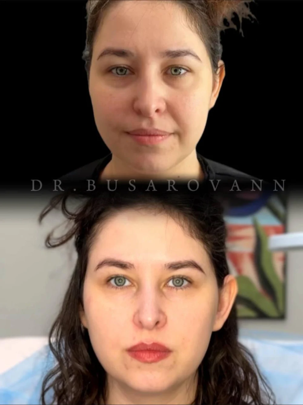 Ботулинотерапия (Ботокс)
