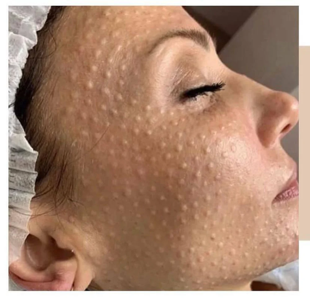 Мезотерапия лица 