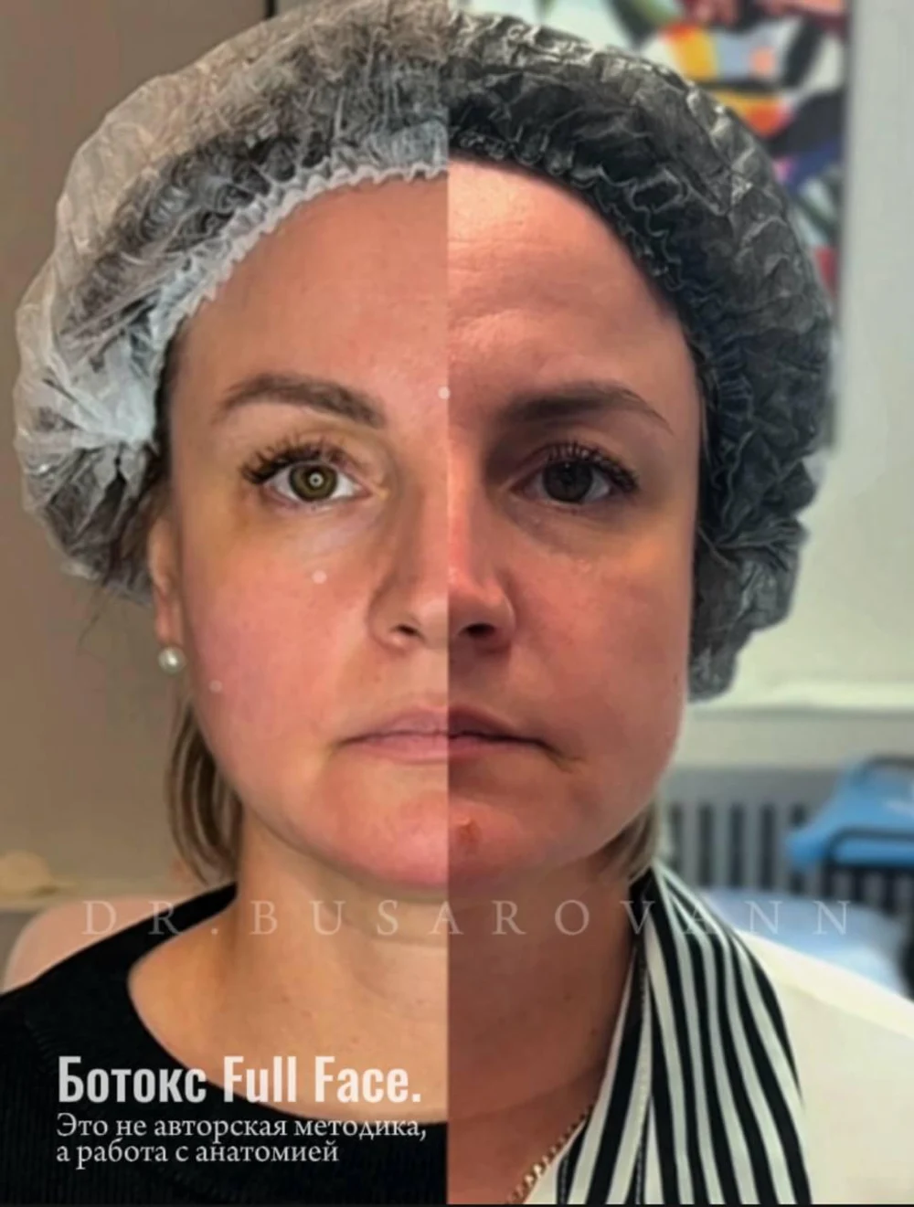 Ботулинотерапия (Ботокс) 