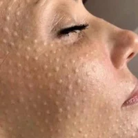 Мезотерапия лица